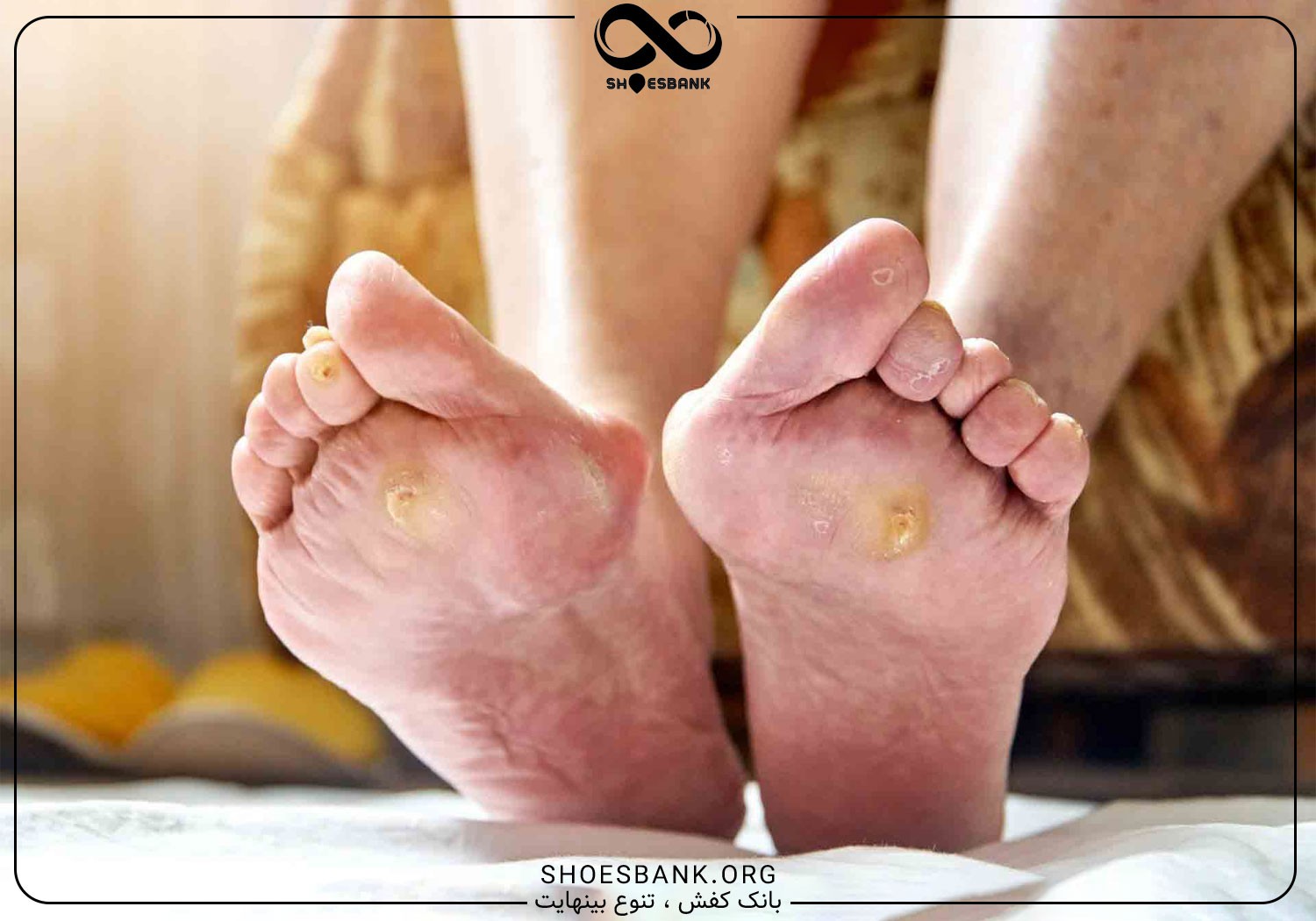 تاول در افراد دیابتی